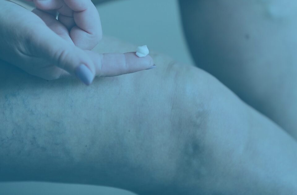 Treatment for Venous Leg Ulcers